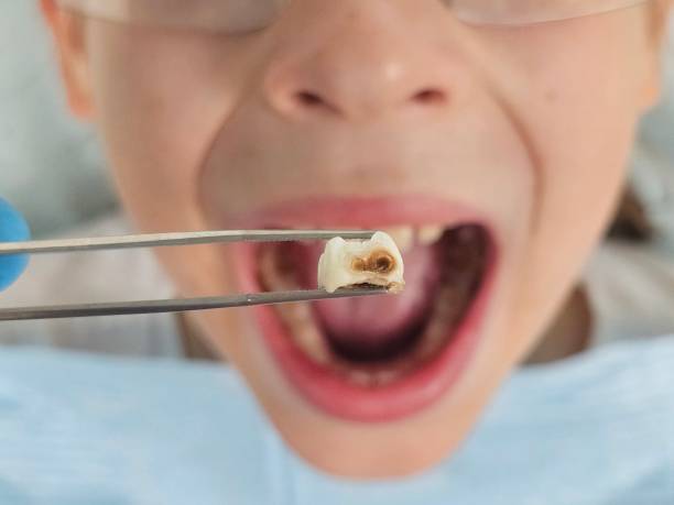 Best Emergency Treatment for Dental Infections or Abscesses in Welsh, LA